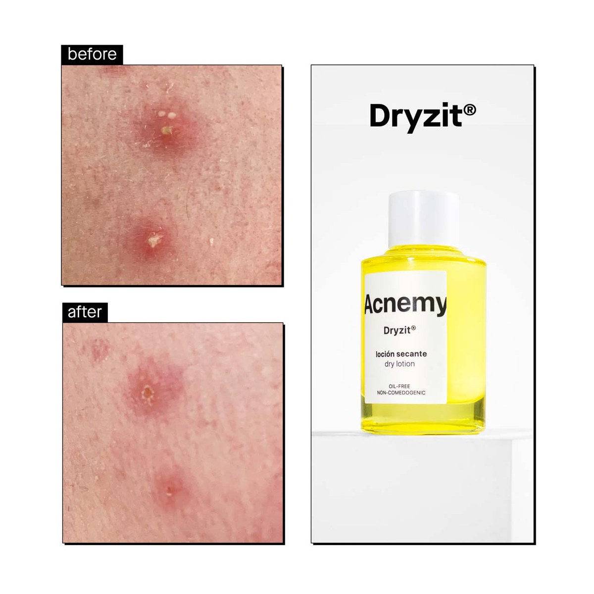 Локальний підсушувальний лосьйон від висипань Dryzit dry lotion